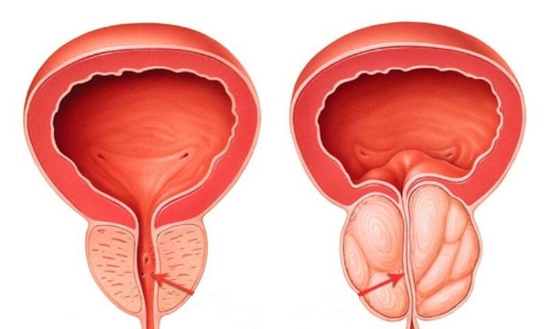 Gesunde und entzündete Prostata mit Prostatitis